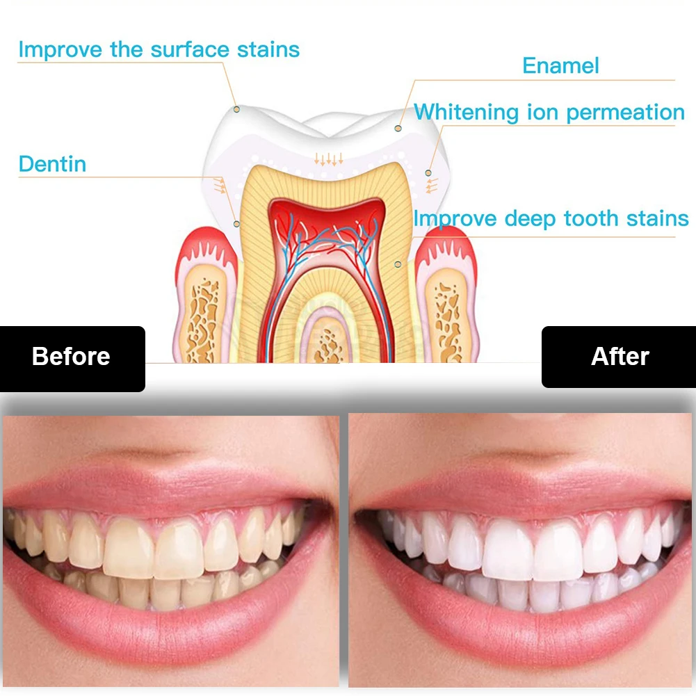 Kit per sbiancamento dei denti - Teeth Whitening Near Me recensione e prezzo